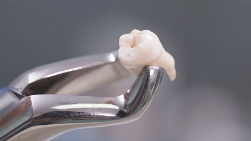 Nhổ răng khôn giá bao nhiêu? Và bao lâu nên khám nha khoa tổng quát 