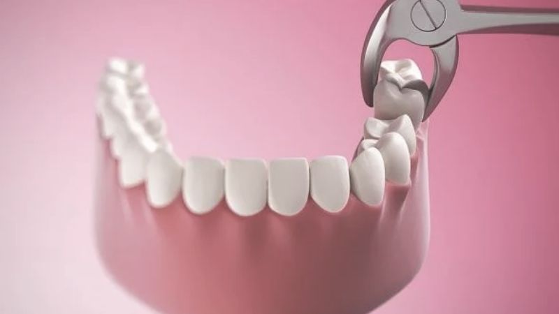 Nhổ răng khôn giá bao nhiêu? Và bao lâu nên khám nha khoa tổng quát 