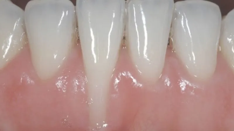 Tại sao phải đi khám nha khoa tổng quát khi bị tụt lợi? 