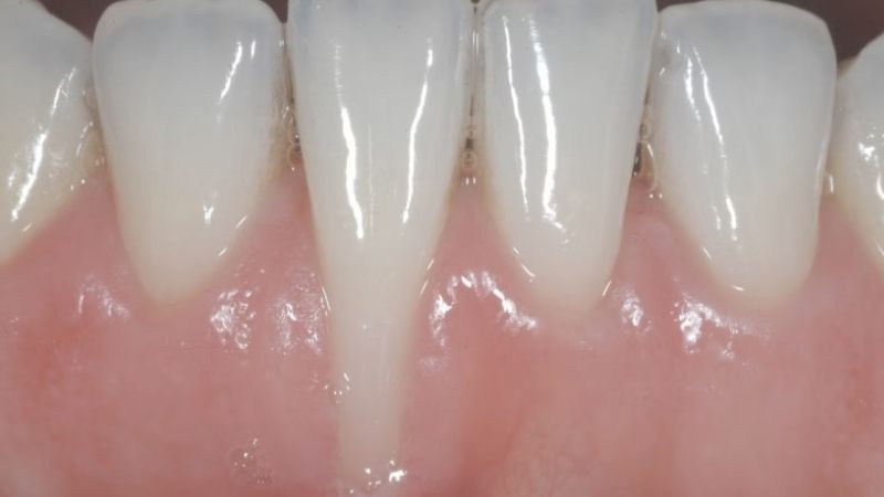 Tại sao phải đi khám nha khoa tổng quát khi bị tụt lợi? 