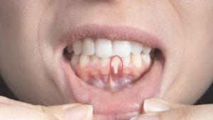 Tại sao phải đi khám nha khoa tổng quát khi bị tụt lợi?