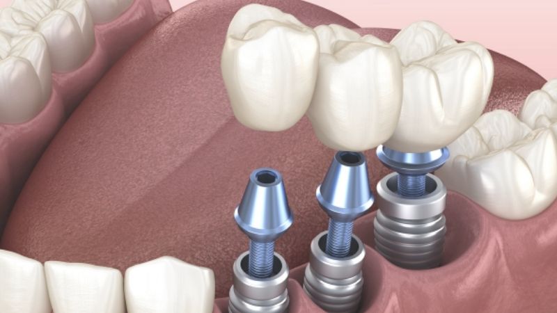 Tại sao nên trồng răng implant? Tác dụng của trồng răng implant là gì?