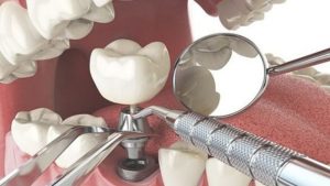 Tại sao nên trồng răng implant? Tác dụng của trồng răng implant là gì?