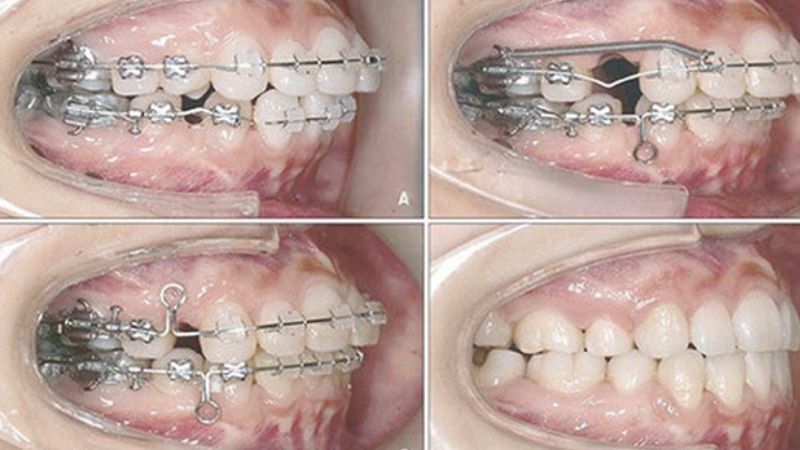 Niềng răng hô có đau không? Niềng răng hô mất bao?