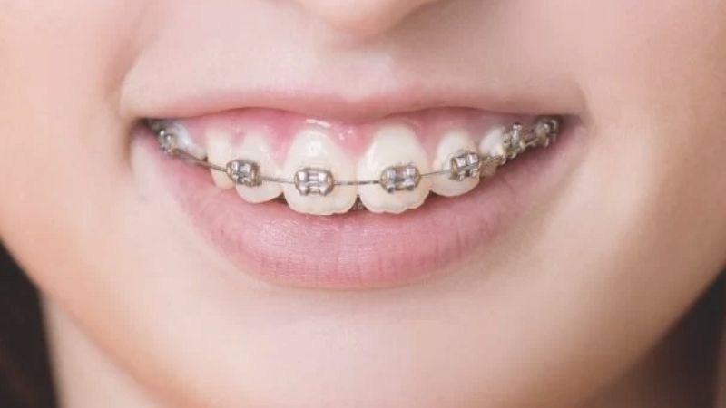 Niềng răng hô có đau không? Niềng răng hô mất bao?