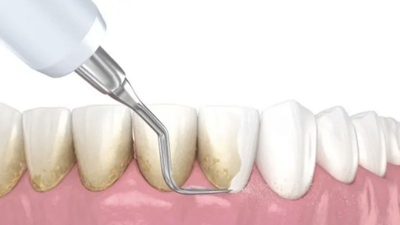 Cập nhật bảng giá cạo vôi răng Tphcm và bảng giá làm răng tại nha khoa ParkWay 