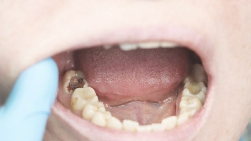 Nếu trẻ bị sâu răng hàm có mọc lại không? Thời gian tham khám nha khoa trẻ em