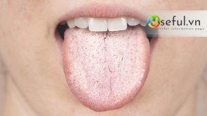 Nguyên nhân bị lưỡi trắng? Khi bị lưỡi trắng có cần khám nha khoa tổng quát không?