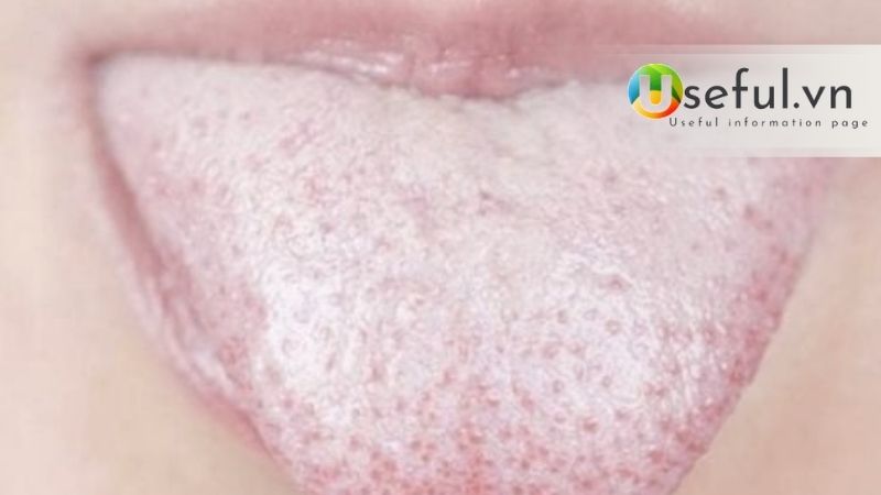 Nguyên nhân bị lưỡi trắng? Khi bị lưỡi trắng có cần khám nha khoa tổng quát không?