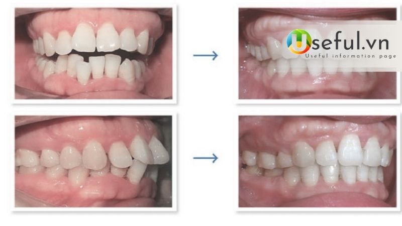 Thường chỉnh 1 răng lệch giá bao nhiêu? Tại sao phải chỉnh răng lệch 