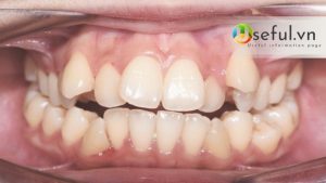 Thường chỉnh 1 răng lệch giá bao nhiêu? Tại sao phải chỉnh răng lệch