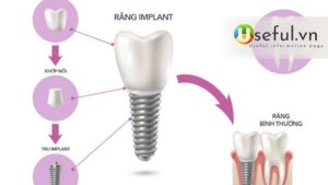 Giá implant thường bao nhiêu? Trồng răng implant tại nha khoa ParkWay