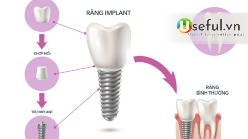 Giá implant thường bao nhiêu? Trồng răng implant tại nha khoa ParkWay 