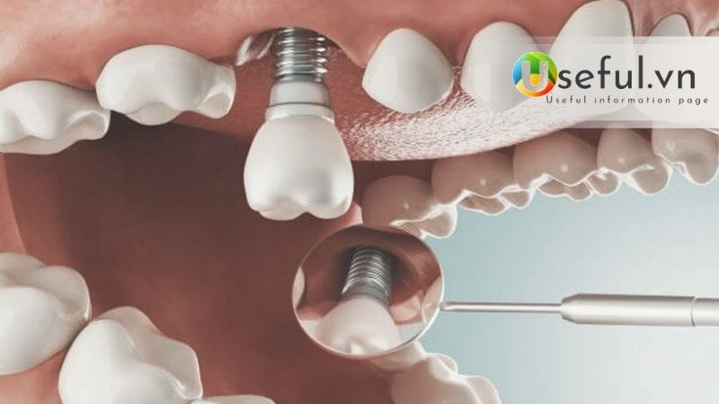 Giá implant thường bao nhiêu? Trồng răng implant tại nha khoa ParkWay 