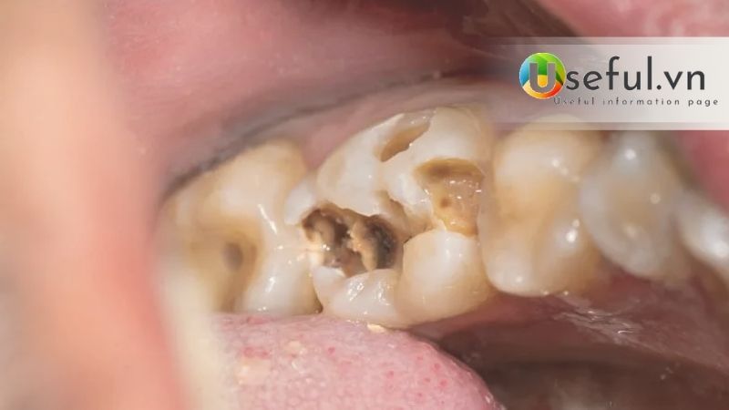 Nhổ răng sâu bao nhiêu tiền? Bao lâu nên khám nha khoa tổng quát?