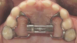 Như thế nào là nong hàm? Nha khoa thẩm mỹ co nong hàm không?