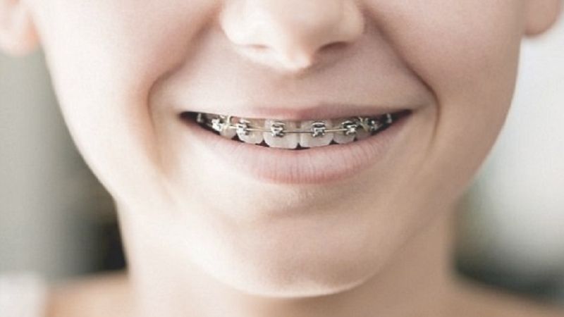 Niềng răng trẻ em - Giải pháp chỉnh nha tối ưu cho nụ cười đẹp