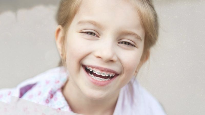 Niềng răng trẻ em - Giải pháp chỉnh nha tối ưu cho nụ cười đẹp