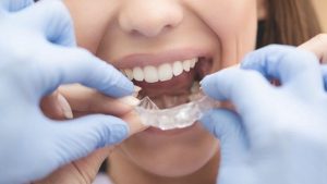 Miếng chống nghiến răng là gì? Nghiến răng có cần khám nha khoa tổng quát?