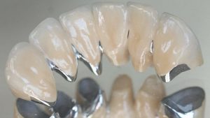 Tìm hiểu bọc răng sứ titan là gì? Có nên bọc răng sứ titan ở nha khoa thẩm mỹ