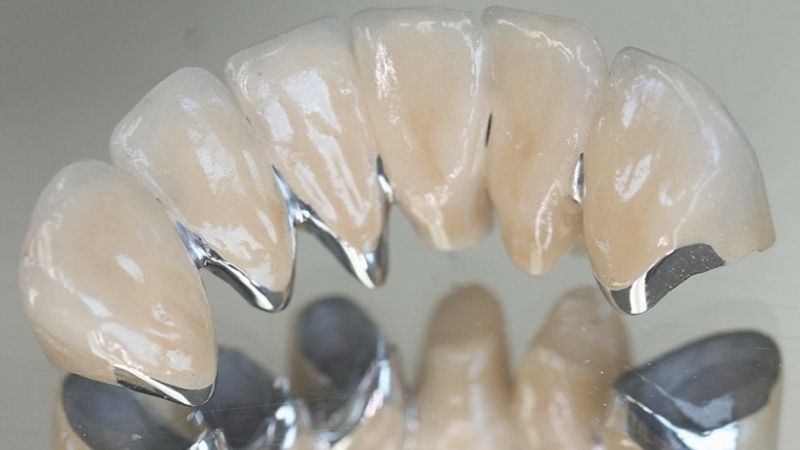 Tìm hiểu bọc răng sứ titan là gì? Có nên bọc răng sứ titan ở nha khoa thẩm mỹ