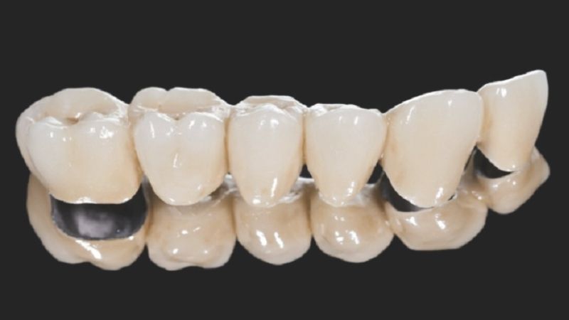 Tìm hiểu bọc răng sứ titan là gì? Có nên bọc răng sứ titan ở nha khoa thẩm mỹ