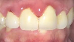 Nguyên nhân và biểu hiện của việc sưng lợi-cách điều trị sưng lợi