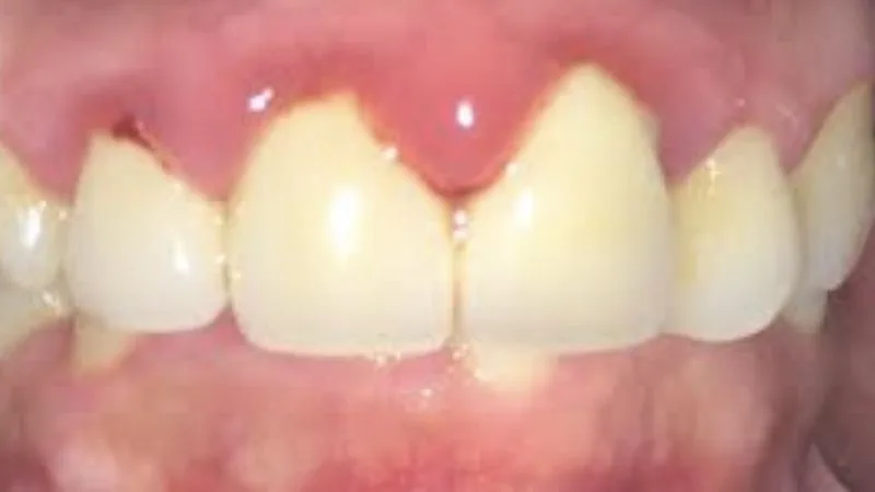 Nguyên nhân và biểu hiện của việc sưng lợi-cách điều trị sưng lợi 
