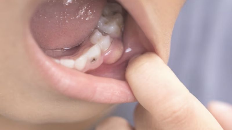 Nguyên nhân và biểu hiện của việc sưng lợi-cách điều trị sưng lợi 