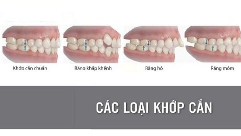 Chỉnh khớp cắn chuẩn để niềng răng có được không?