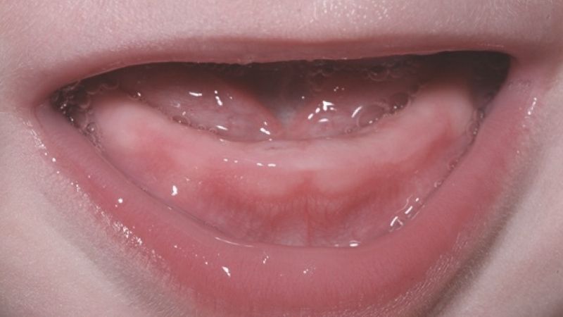 Những dấu hiệu trẻ mọc răng lần đầu ba mẹ nên lưu ý 