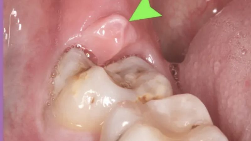 Thường nhổ răng khôn bao nhiêu tiền? Cập nhật bảng giá nhổ răng khôn 