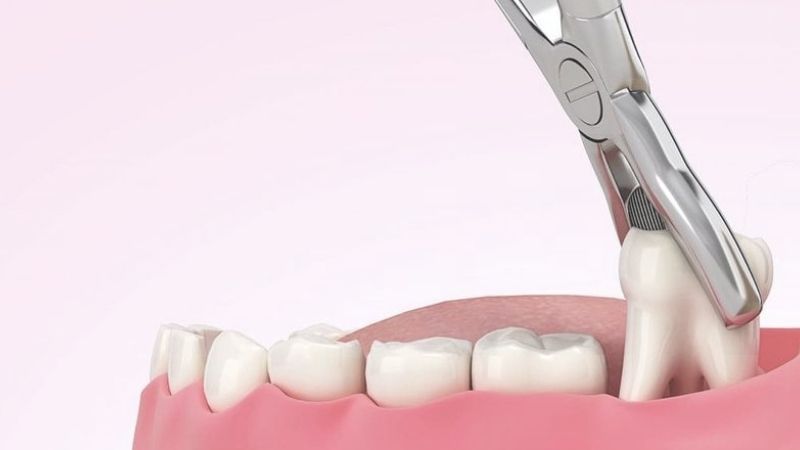 Thường nhổ răng khôn bao nhiêu tiền? Cập nhật bảng giá nhổ răng khôn 