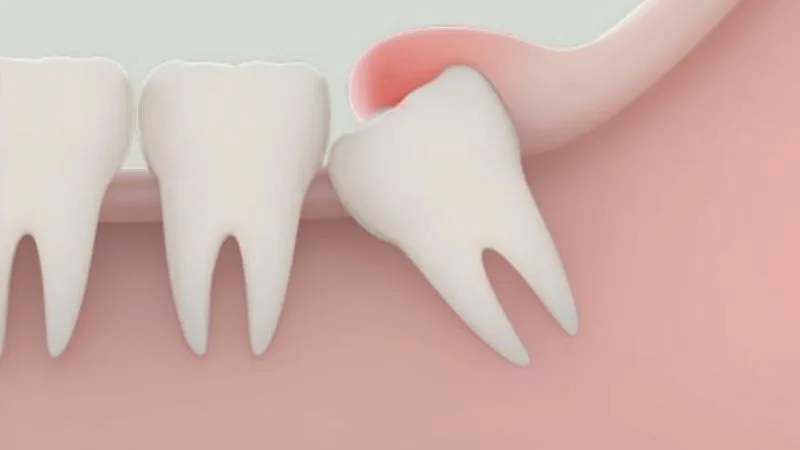 Sau khi nhổ răng khôn kiêng ăn gì? Các loại đồ ăn không nên ăn khi nhổ răng khôn