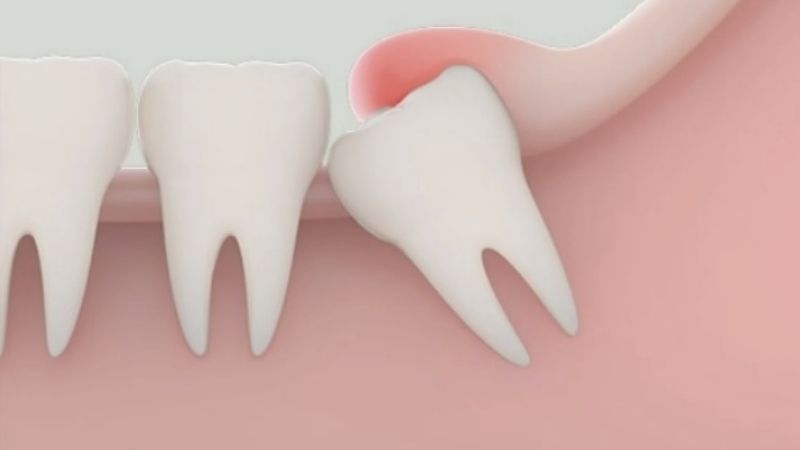 Sau khi nhổ răng khôn kiêng ăn gì? Các loại đồ ăn không nên ăn khi nhổ răng khôn