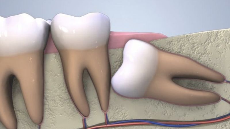 Sau khi nhổ răng khôn kiêng ăn gì? Các loại đồ ăn không nên ăn khi nhổ răng khôn
