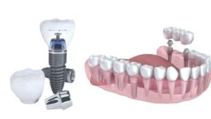 Giải đáp thắc mắc trồng răng implant có đau không?