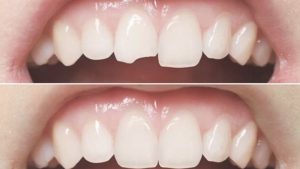 Cập nhật bảng giá trám răng cửa tại nha khoa Park Way