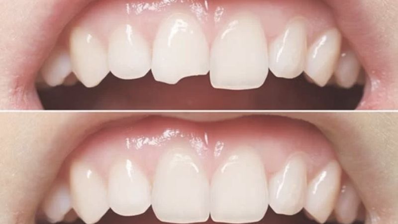 Cập nhật bảng giá trám răng cửa tại nha khoa Park Way 