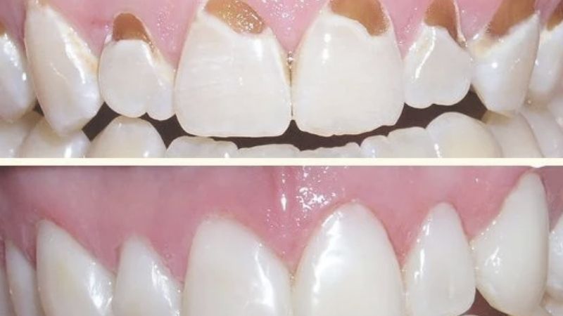 Cập nhật bảng giá trám răng cửa tại nha khoa Park Way 