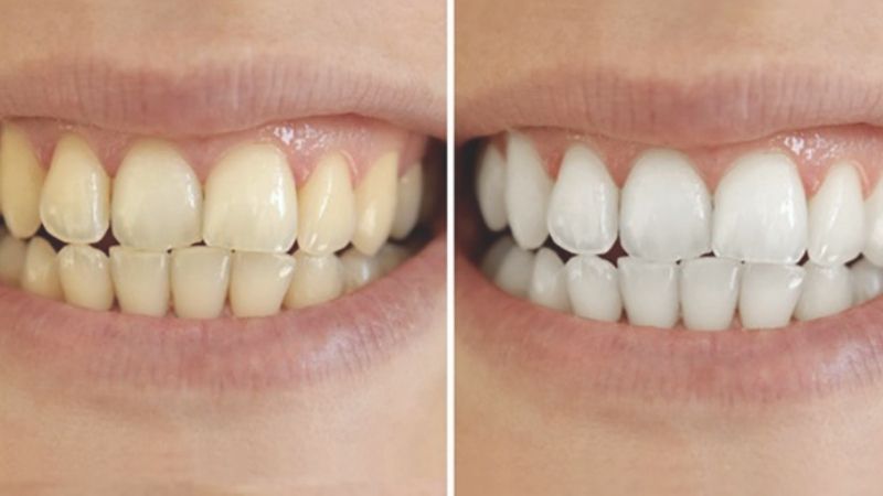 Bảng giá tẩy trắng răng nha khoa có đắt hay không?