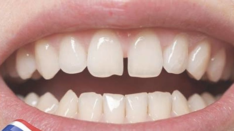 Thường trám răng cửa bao nhiêu tiền?