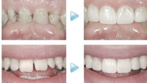 Thường trám răng cửa bao nhiêu tiền?