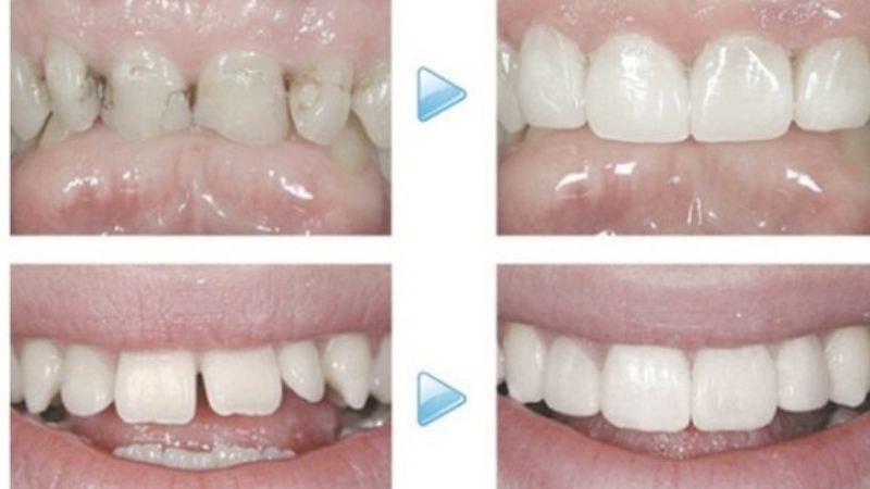 Thường trám răng cửa bao nhiêu tiền?