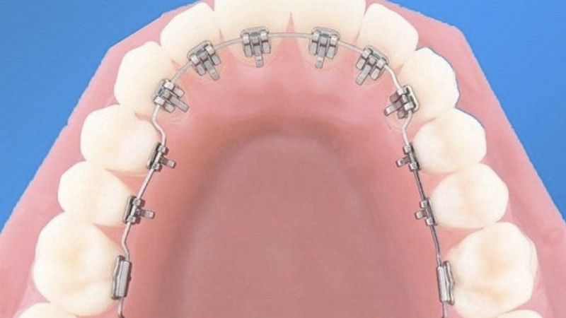 Niềng răng mặt trong: Giải pháp chỉnh nha hiện đại thẩm mỹ 2025