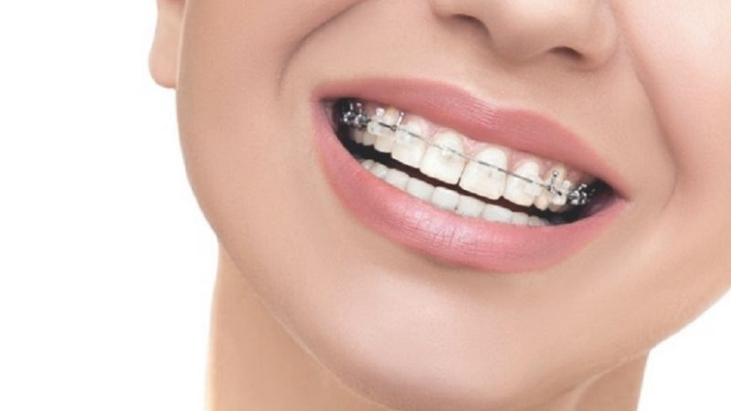 Niềng răng bao nhiêu tiền 1 hàm? Chi phí khi niềng răng là bao nhiêu?