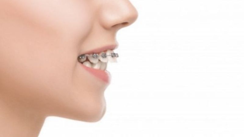 Niềng răng bao nhiêu tiền 1 hàm? Chi phí khi niềng răng là bao nhiêu?