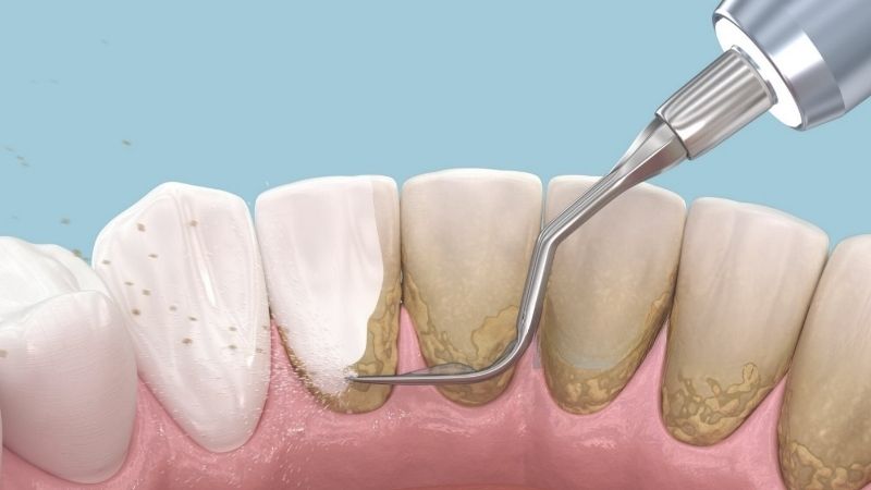 Lấy cao răng có đau không? Nha khoa thẩm mỹ có lấy cao răng không?