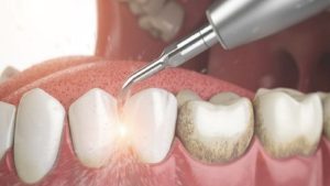 Lấy cao răng có đau không? Nha khoa thẩm mỹ có lấy cao răng không?