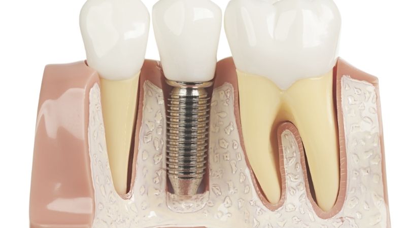 Bảng giá dịch vụ cấy ghép implant tại nha khoa Park Way 